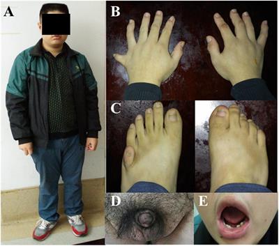 Ocular Characteristics of Patients With Bardet–Biedl Syndrome Caused by Pathogenic BBS Gene Variation in a Chinese Cohort